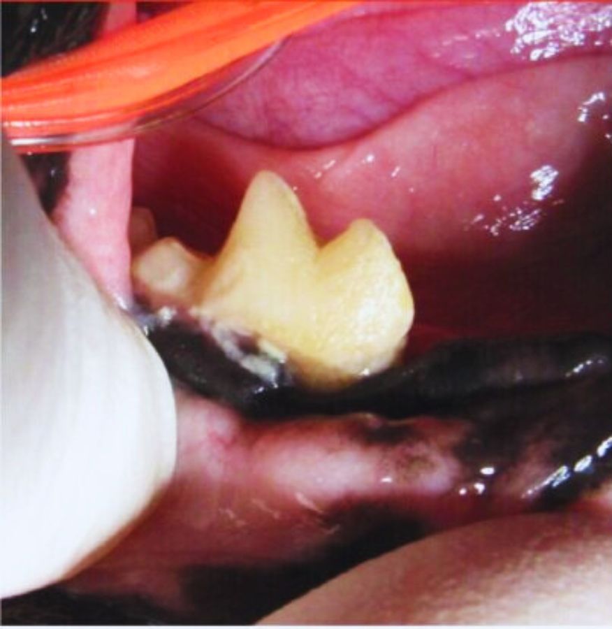 Tough plaque build up results in calculus which cannot be remove by brushing the dog's teeth